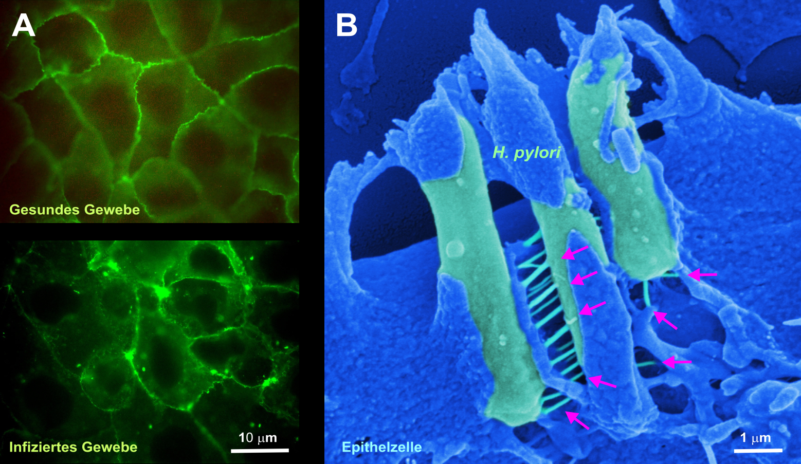 Zum Artikel "Wie Helicobacter pylori Magenkrebs auslöst"