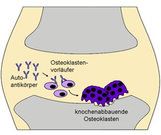 Zum Artikel "Immunsystem und Knochen – Eine gefährliche Allianz"