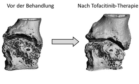 Zum Artikel "Rheuma und die Knochenheilung – Zwei Fliegen mit einer Klappe"